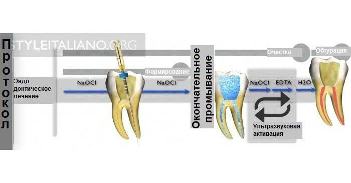 Обработка канала гипохлоритом. Лазерная терапия корневых каналов. Эндодонт это в стоматологии.