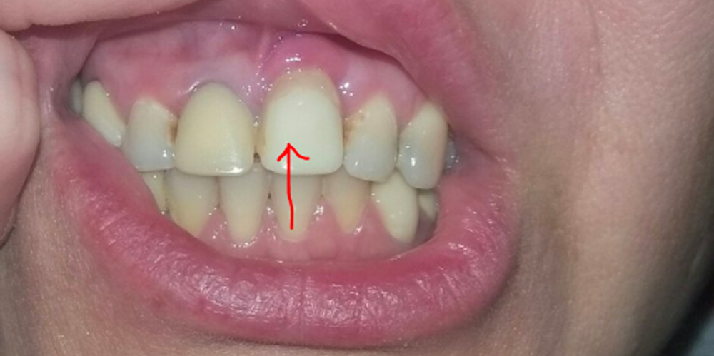 Подлежит ли зуб удалению? - фото №2
