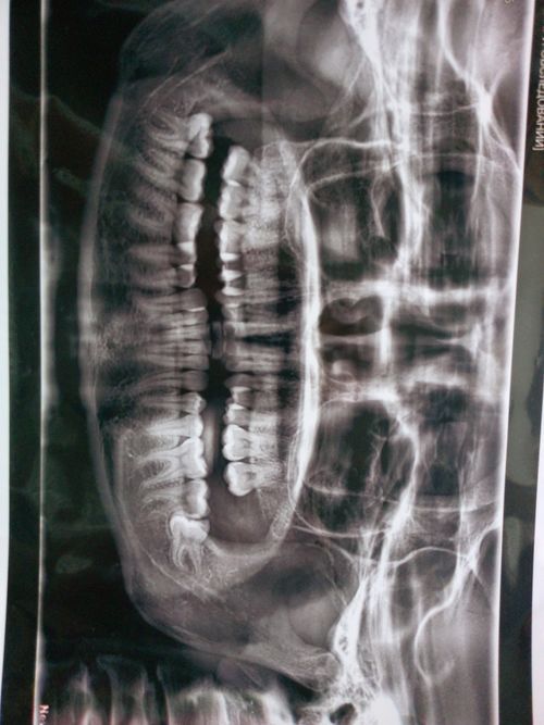 Здравствуйте, у меня зуб мудрости не правильно растет - фото №1