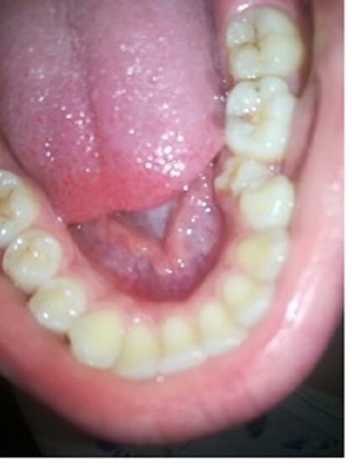 Каким образом можно исправить положение зуба в нижней челюсти? - фото №1