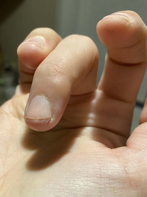 Глубокие трещины на пальцах рук - фото №1
