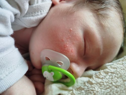 Прыщики у новорожденного - фото №1