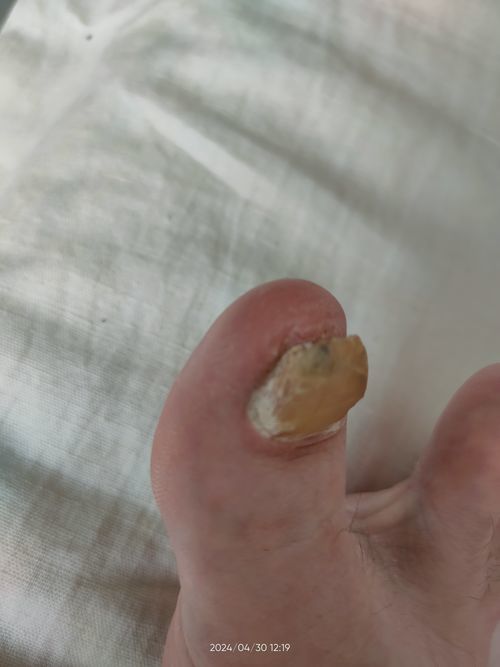 Изменение формы ногтя большого пальца на ноге - фото №1