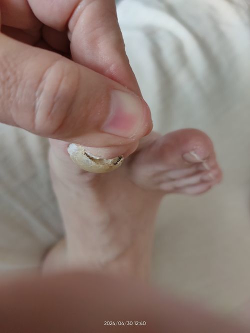 Изменение формы ногтя большого пальца на ноге - фото №2