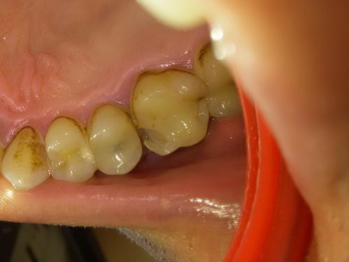 Сколько можно тянуть с лечением 26-го зуба. Фото и снимок. - фото №2