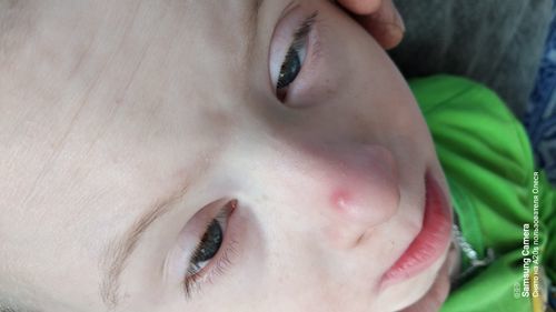 Покраснение на носу у ребенка 7 лет. - фото №1