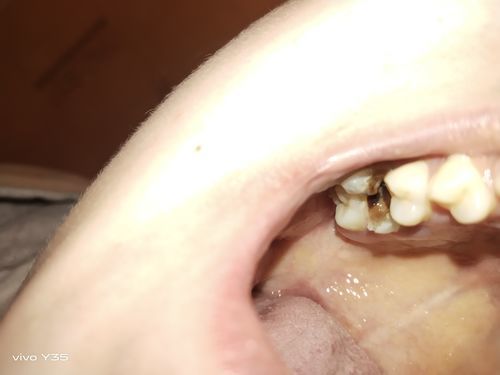 Сложное удаление зуба - фото №3