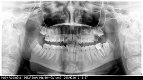 Боль в нижних зубах - фото №1