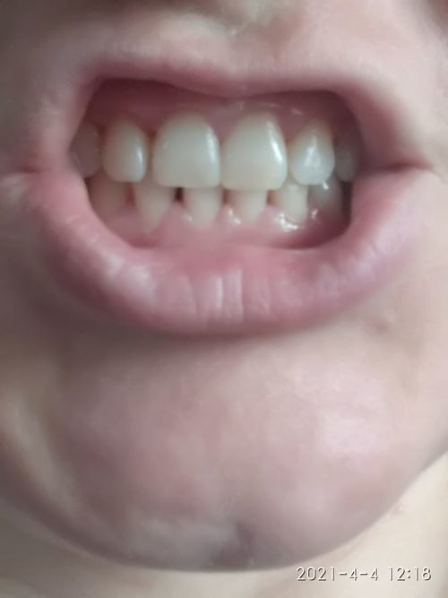 Зубы, десна - фото №1
