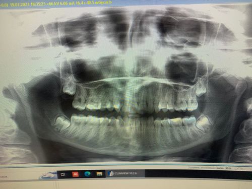 Удаление зубов мудрости - фото №1
