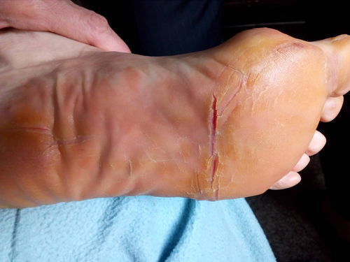 Сухость кожи и образование глубоких болезненных трещин на ступнях ног и на ладонях рук - фото №1