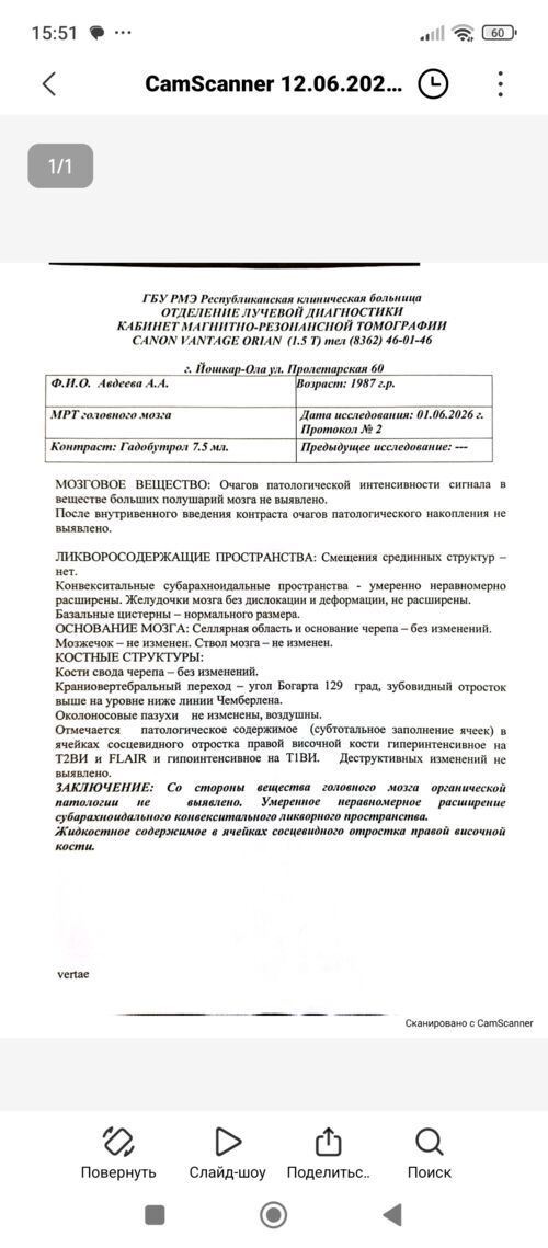 Неврит зрительного нерва - фото №12