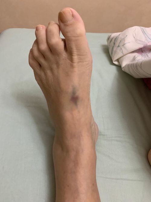 Вена на ноге после тромбоэктомии - фото №1