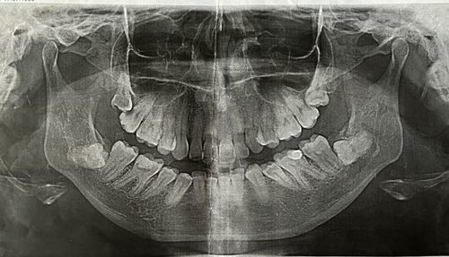 Удаление нижних зубов мудрости - фото №1