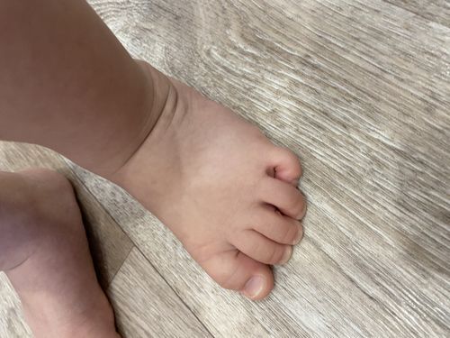 Искривление мизинца на ноге у ребёнка - фото №1