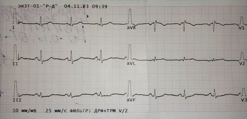 Подскажите по ЭКГ, а то я уже запутался - фото №1