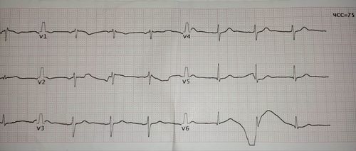 Подскажите по ЭКГ, а то я уже запутался - фото №2