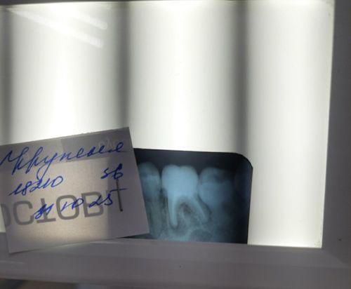 Восстановление зуба, распорка, снятие воспаления? - фото №1