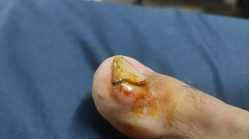 Воспаление на пальце ноги, гной - фото №1