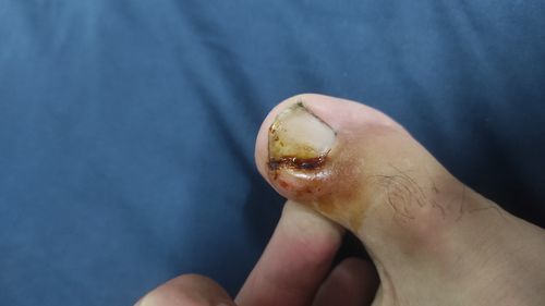 Воспаление на пальце ноги, гной - фото №3