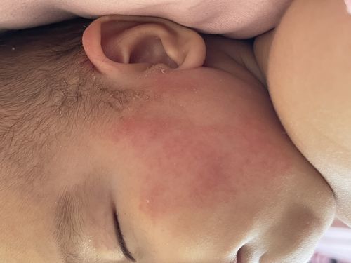Аллергия на лице ребенка - фото №1