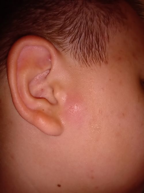 опухоль возле уха у  подростка - фото №1