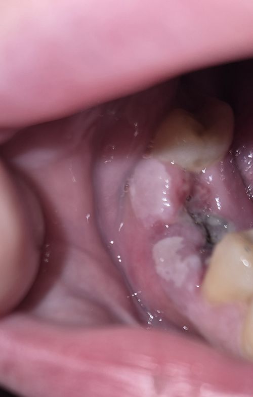 Заживление лунки после удаления зуба - фото №1