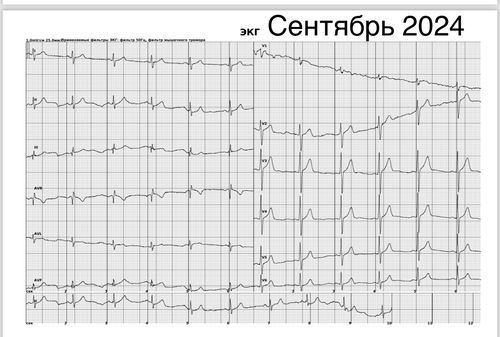 Заключение ЭКГ нарушение проводимости - фото №4