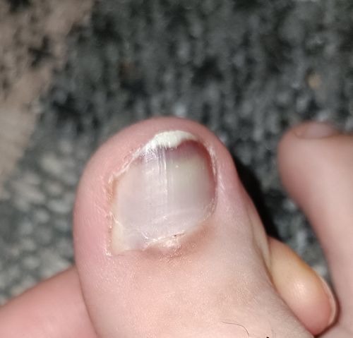 Выдернула ногтевую пластину из валика . - фото №1