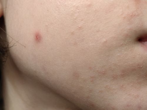 Что делать, если уже 3 недели подряд появляется периоральный дерматит. - фото №2