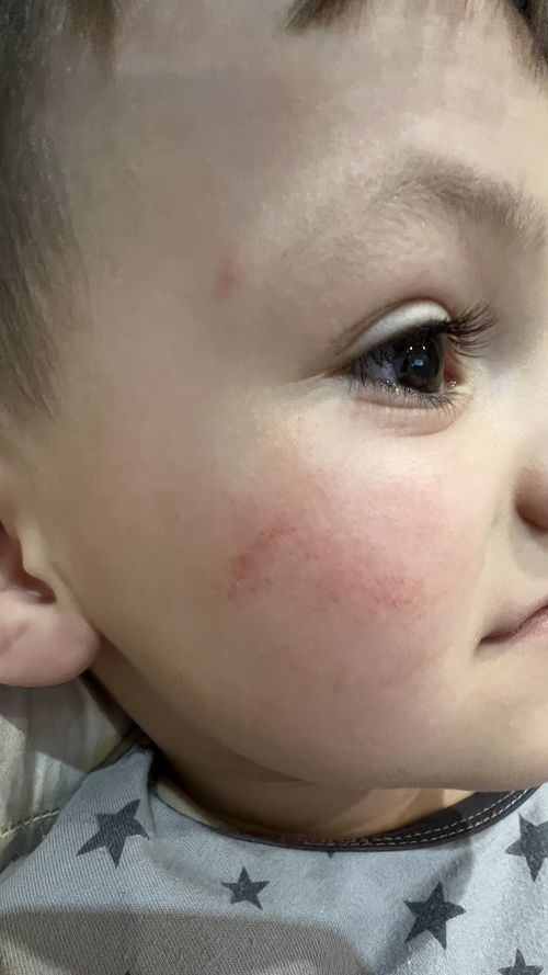 Красные точки как лопнувшие капилляры на лице у ребенка - фото №1