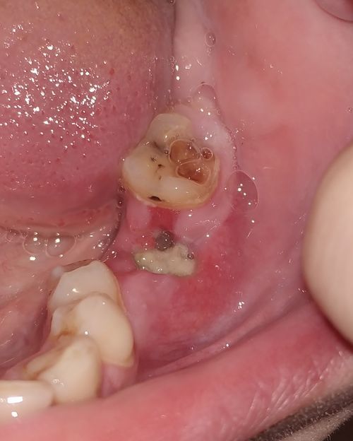 Боли после удаления зуба  спустя 6 дней - фото №1