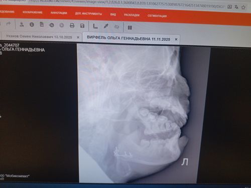Операция на челюсть титановая пластина - фото №1