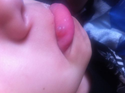 Сын 10 лет нужно удаление ретеционной кисты нижней губы - фото №1