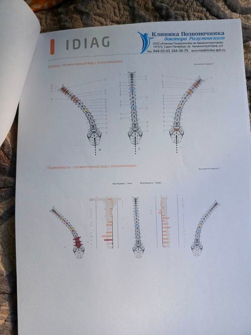 усиленный кифоз болезнь шейермана мау - фото №5