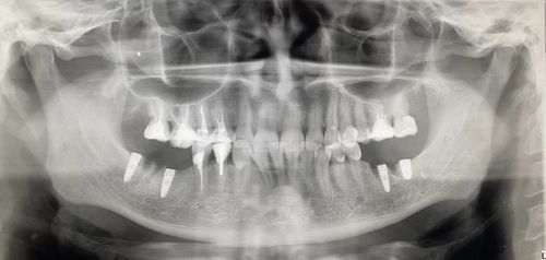 Узкие импланты Mis Seven диаметром 3.3 в жевательных зубах (6,7) - фото №1