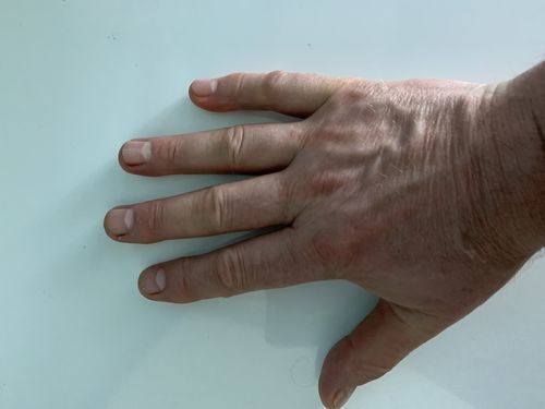 Скованность суставов пальцев рук в ночное и утреннее время - фото №1