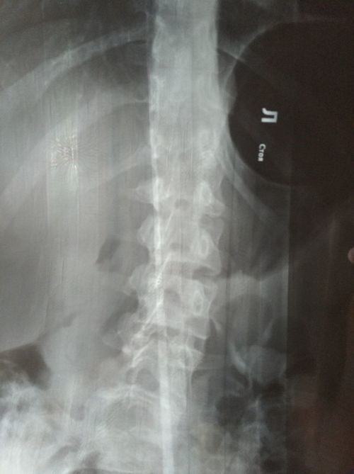 сколиоз является противопоказанием к эпидуральной анестезией? - фото №2