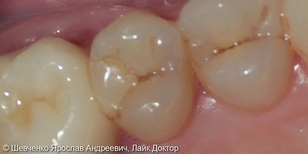 Лечение кариеса зуба 2.5 - фото №1