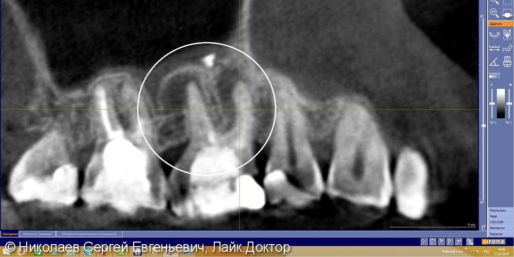Повторное эндодонтическое лечение 16 зуба, перелечивание каналов зуба до и после - фото №1