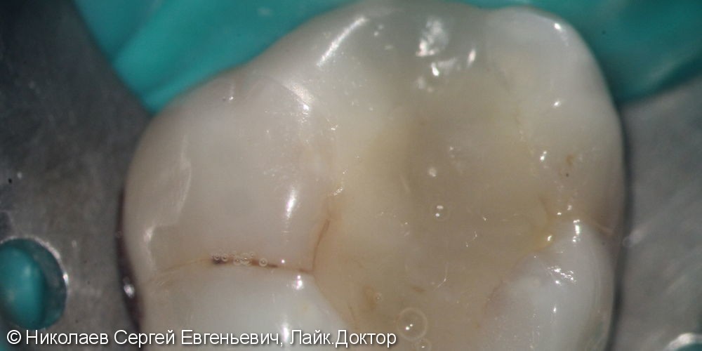 Повторное эндодонтическое лечение 16 зуба, перелечивание каналов зуба до и после - фото №2
