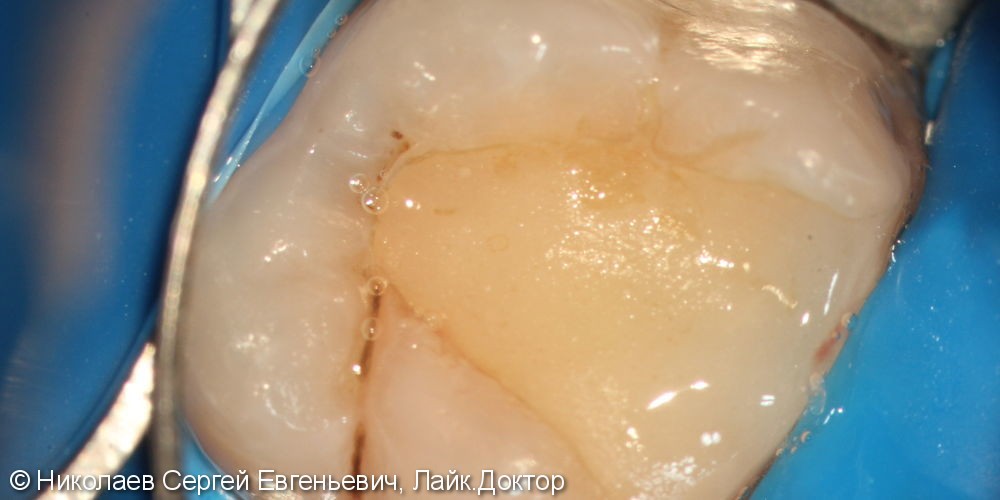 Лечение хронического апикального периодонтита 26 (киста зуба) - фото №1