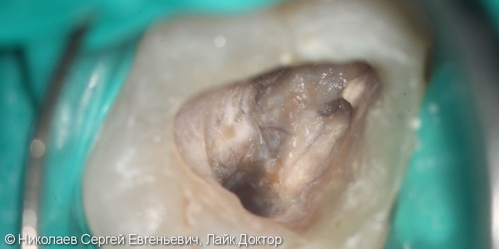 Лечение хронического апикального периодонтита 26 (киста зуба) - фото №3