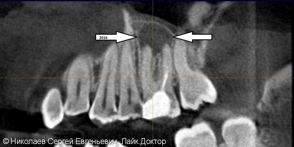 Лечение хронического апикального периодонтита 26 (киста зуба) - фото №5
