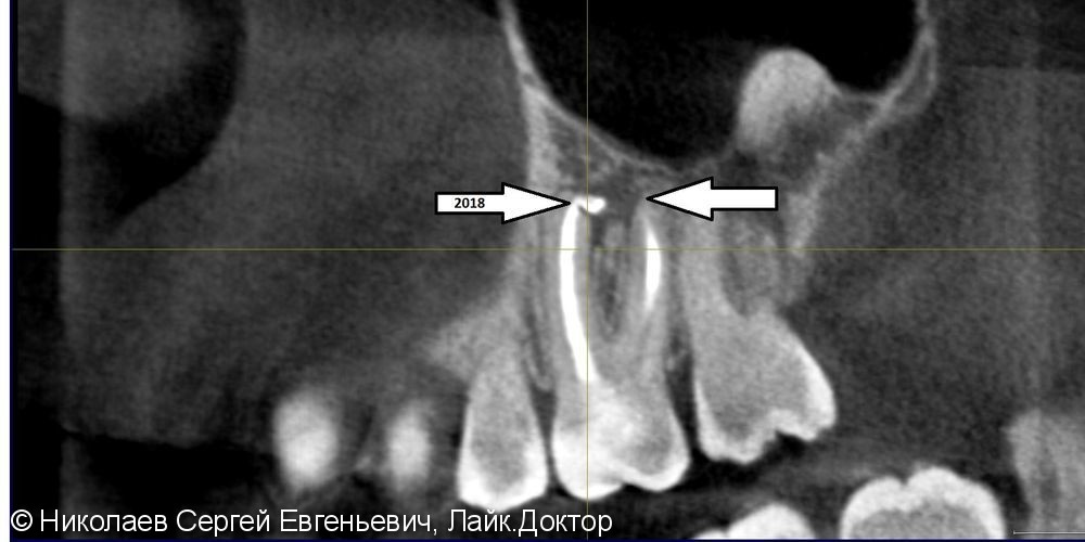 Лечение хронического апикального периодонтита 26 (киста зуба) - фото №6