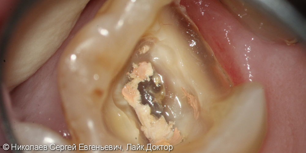 Эндодонтическое лечение 26 зуба, "киста", до и после - фото №2