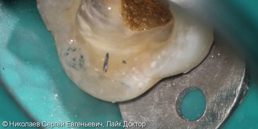 Эндодонтическое лечение 26 зуба, "киста", до и после - фото №4