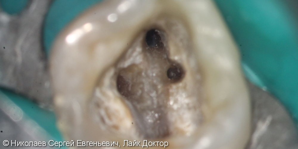 Эндодонтическое лечение 26 зуба, "киста", до и после - фото №5