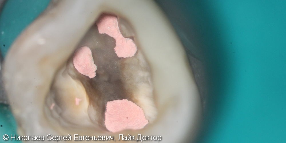 Эндодонтическое лечение 26 зуба, "киста", до и после - фото №6