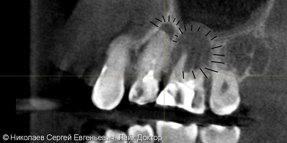 Эндодонтическое лечение 26 зуба, "киста", до и после - фото №7